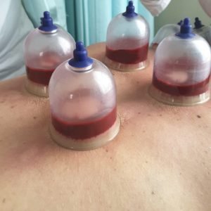 Wet Cupping & Blood Letting - Liverpool
